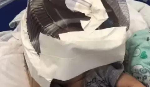 Morre bebê que usou respirador improvisado com embalagem de bolo no RN